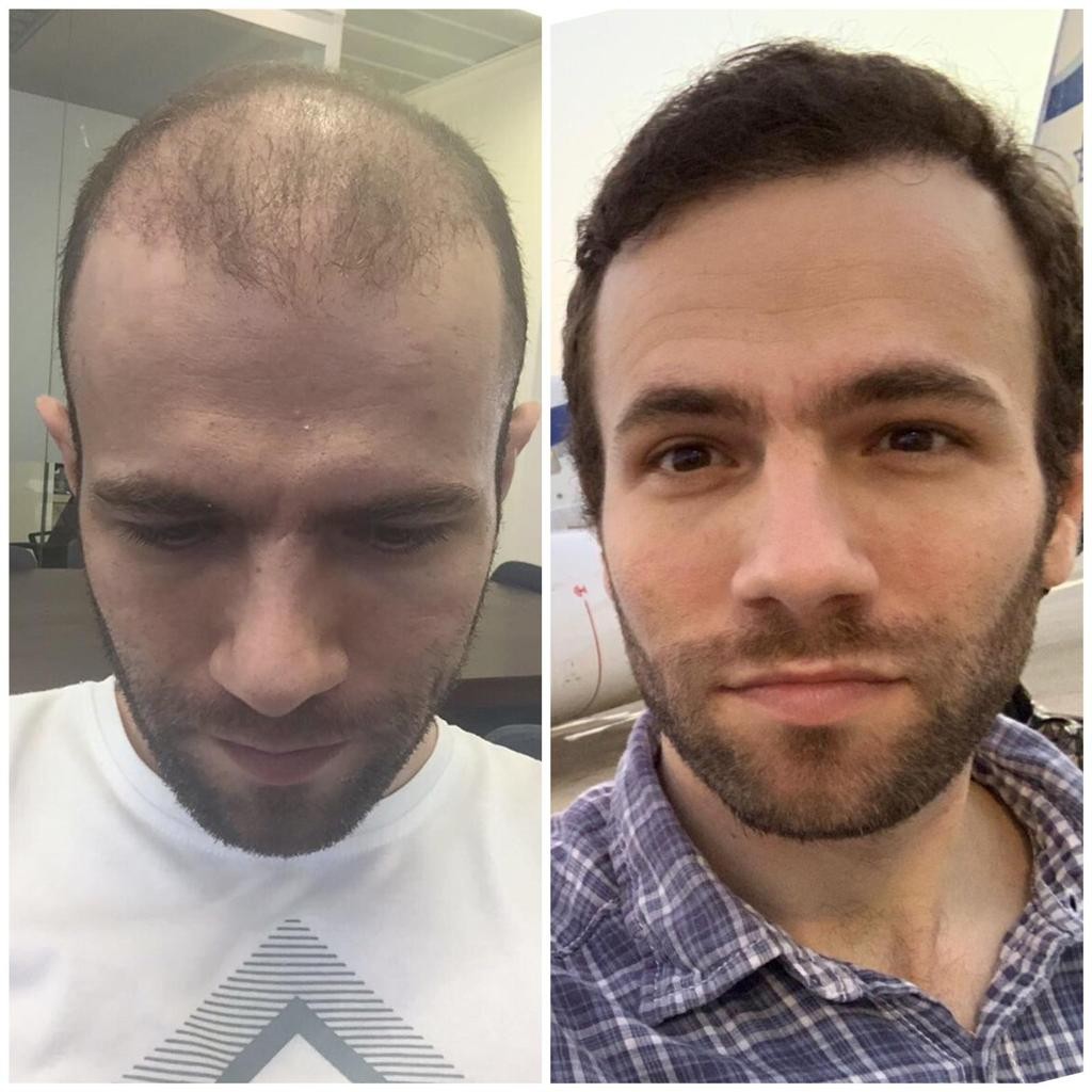 "קרחת זו לא גזירת גורל"