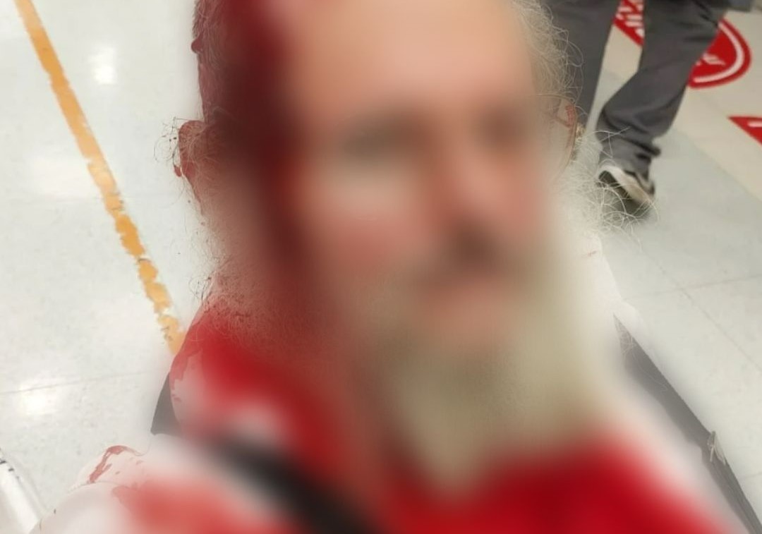 גבר יהודי נכנס לכפר הערבי חוסאן ונפצע מיידוי אבנים