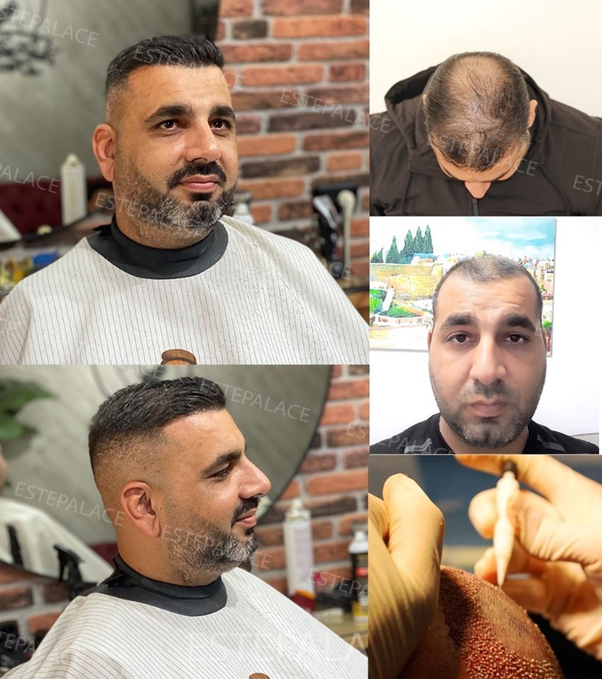 השתלת שיער בטורקיה DHI חוזרים למראה הצעיר
