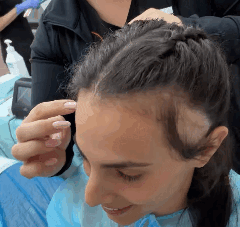 לינוי אשרם עברה השתלת שיער וחשפה את הסיבה לקרחות בצידי הראש